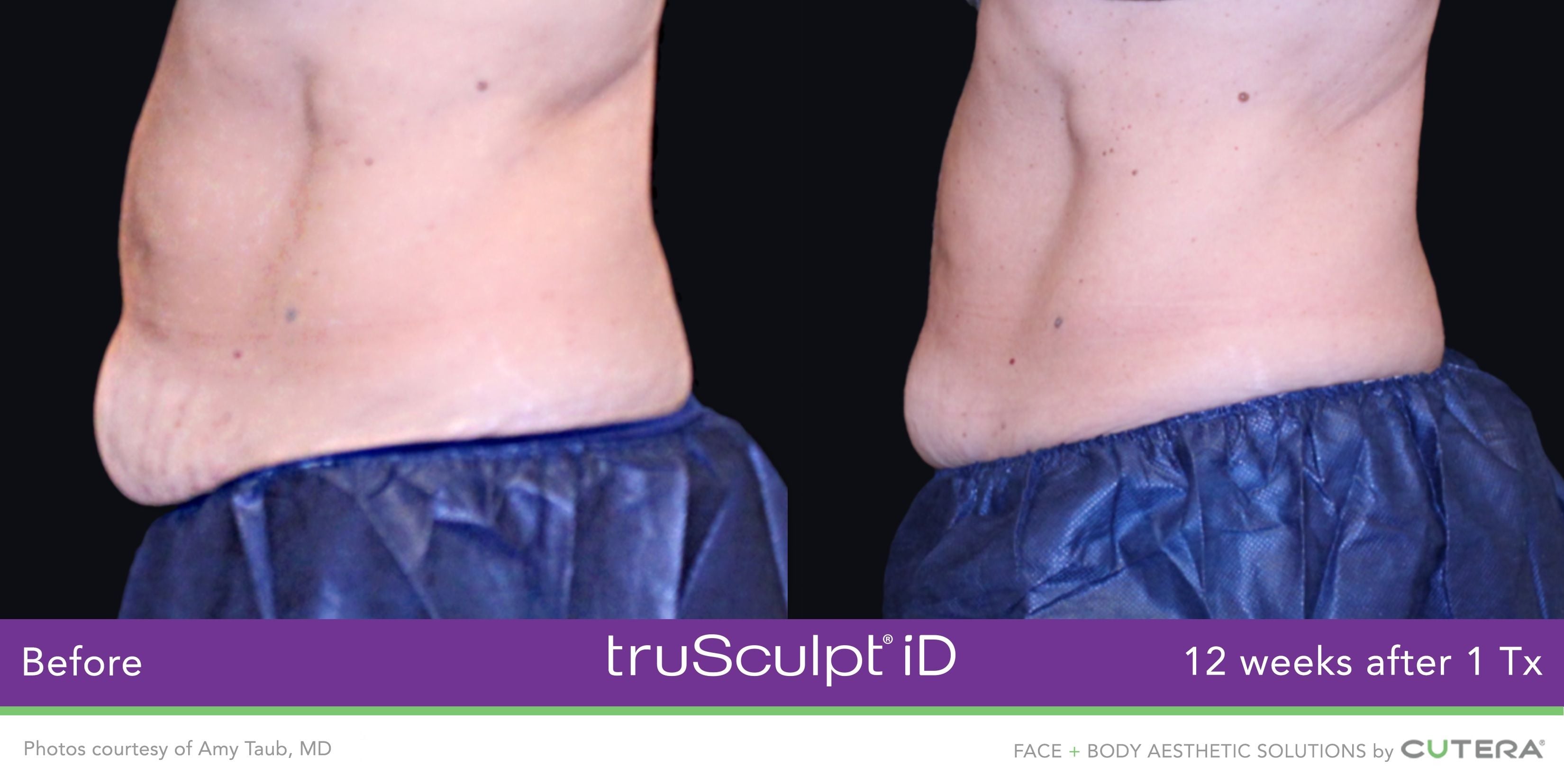 truSculpt Flex Results Image -6398c8ef5c9f4
